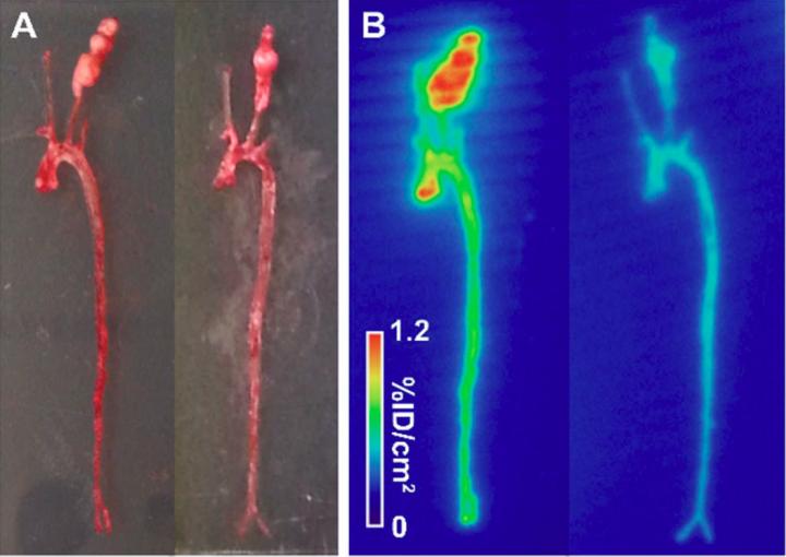 Tc-99m-RYM1 Imaging of Carotid Aneurysm.