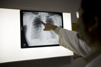 Tuberculosis Vulnerability