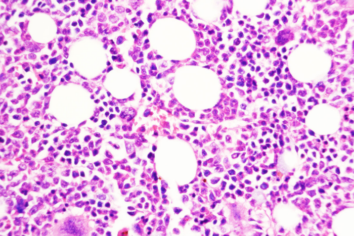 Study Reveals How Chronic Blood Cancer Transitions to Aggressive Disease