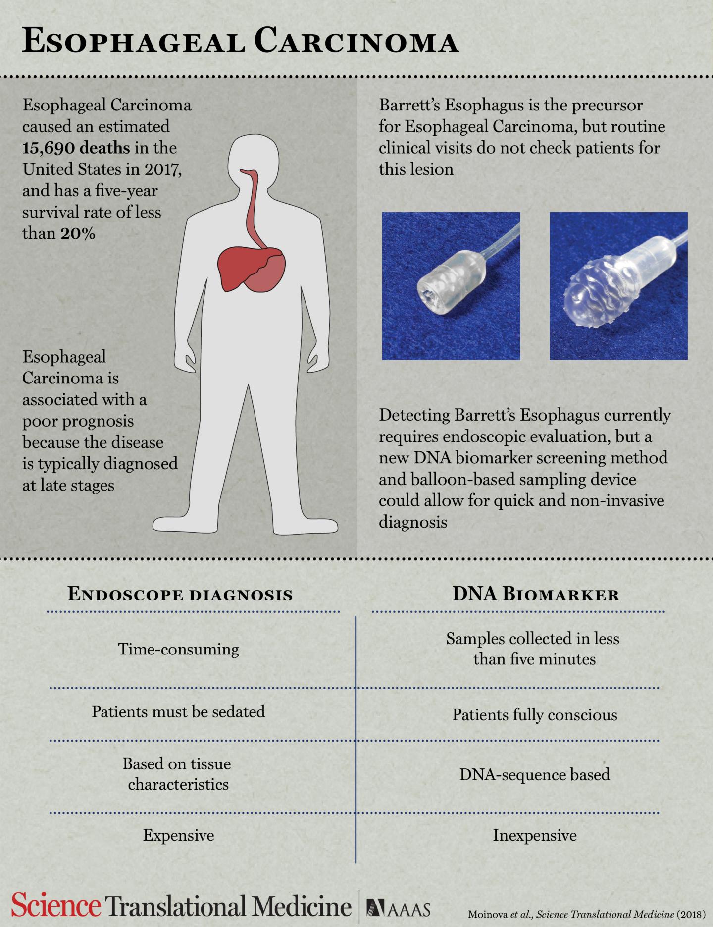 Swollawable Balloon Offers Noninvasive Detection for Esophageal Cancer Risk (1 of 7)