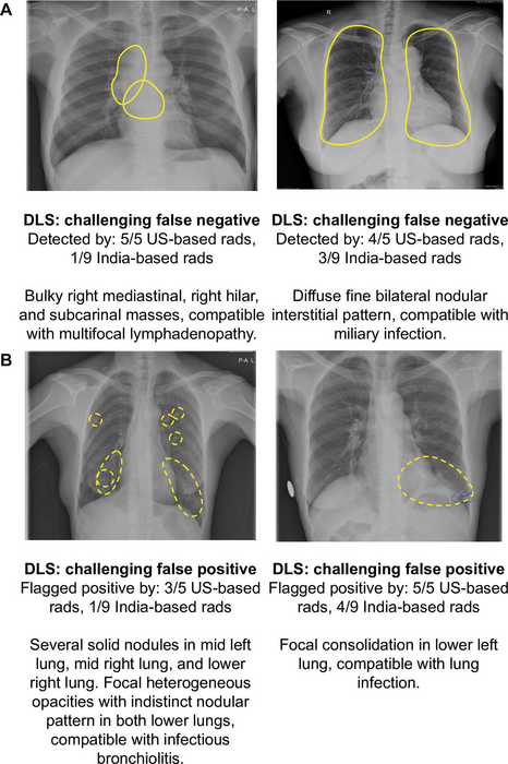 AI-based System Shows Promise in Tuberculosis Detection