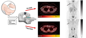 Novel 68Ga-FAPI PET/CT offers oncologic staging without COVID-19 vaccine-related pitfalls.