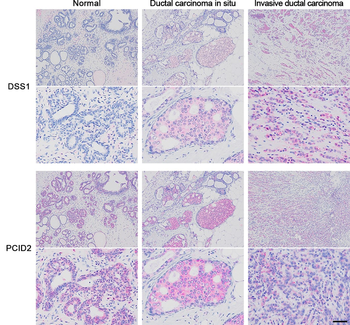 Immunohistochemistry showing DSS1 and PCID2 in normal and cancerous breast tissues