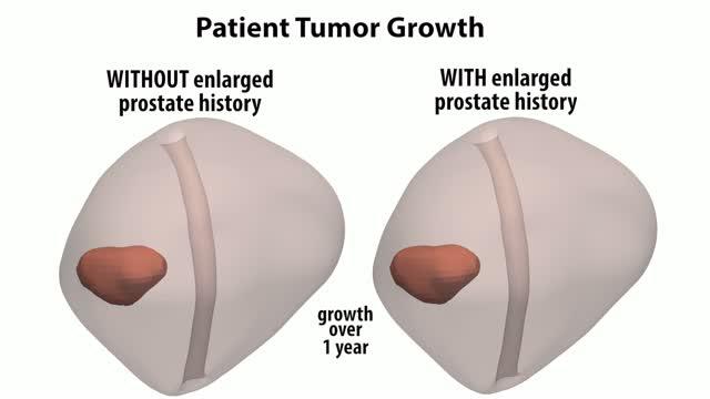 Enlarged Prostate Stops Prostate Cancer Growth