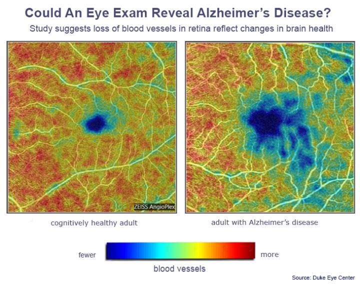 Could An Eye Doctor Diagnose Alzheimer's Before You Have Symptoms?