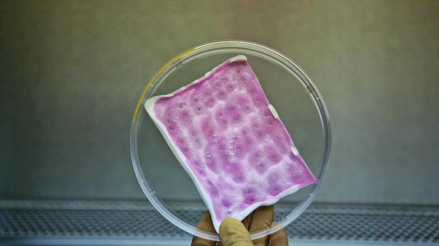 Infection-Fighting Bandage for the Treatment of Severe Burns (1 of 3)