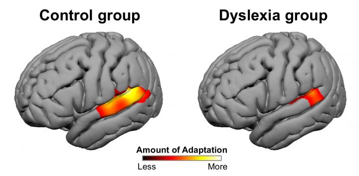 Dyslexic Brains Versus Control Group (1 of 2)