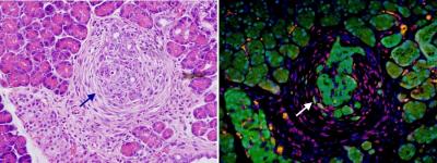 Metastasis of Pancreatic Cancer in Action