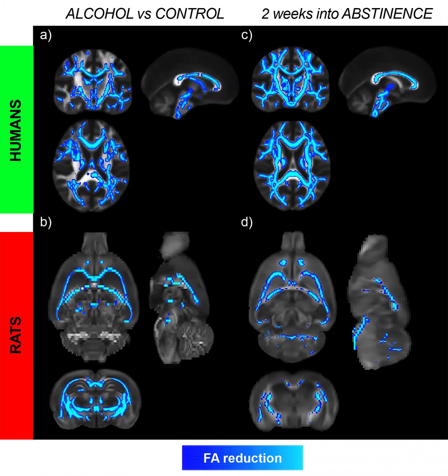 Microstructural Changes In Brain White Matter