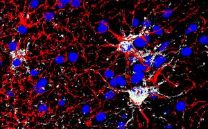 GFAP (red) Gal3 (white) DAPI (blue) gliosis hemorrhage