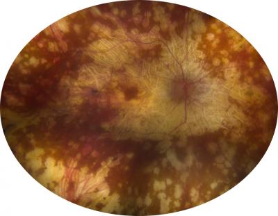 Image of a Retina Affected by Sympathetic Ophthalmia