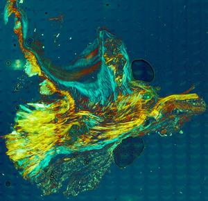 Calcium nodules in aortic valve