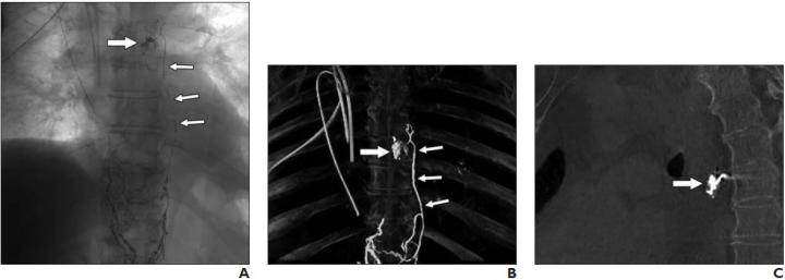 76-Year-Old Man Who Underwent Esophagectomy and Thoracic Duct Ligation