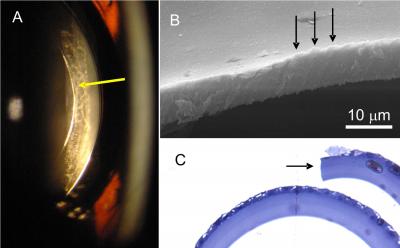 3-D Imaging Guides Femtosecond Laser in Cataracts Removal (8 of 10)