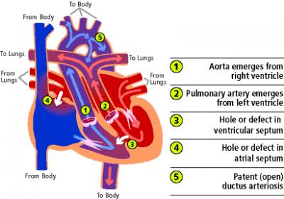 Diagram of Transposition of the Great Arteries
