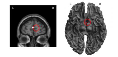 Activation of Hand Radical in Right Medial Frontal Gyrus