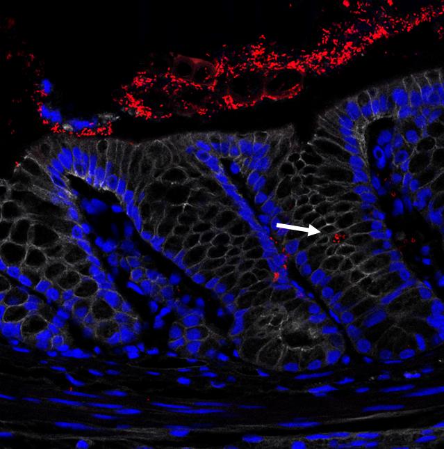 Large Bowel Showing Inflammation