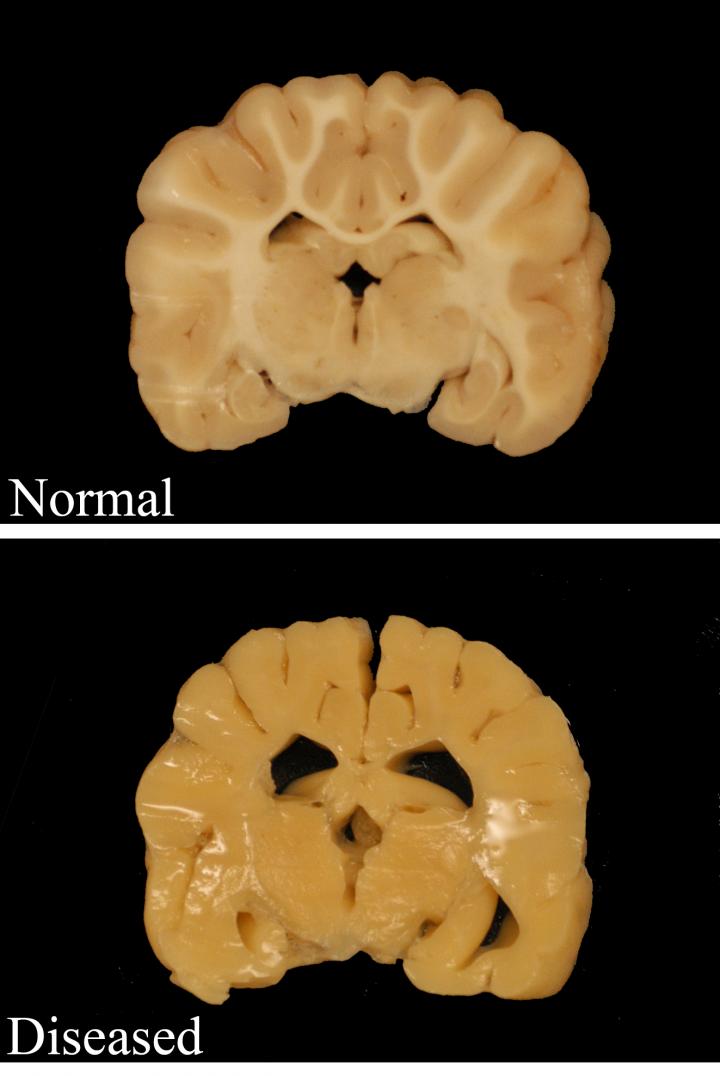 Pelizaeus Merzbacher Disease in Brain
