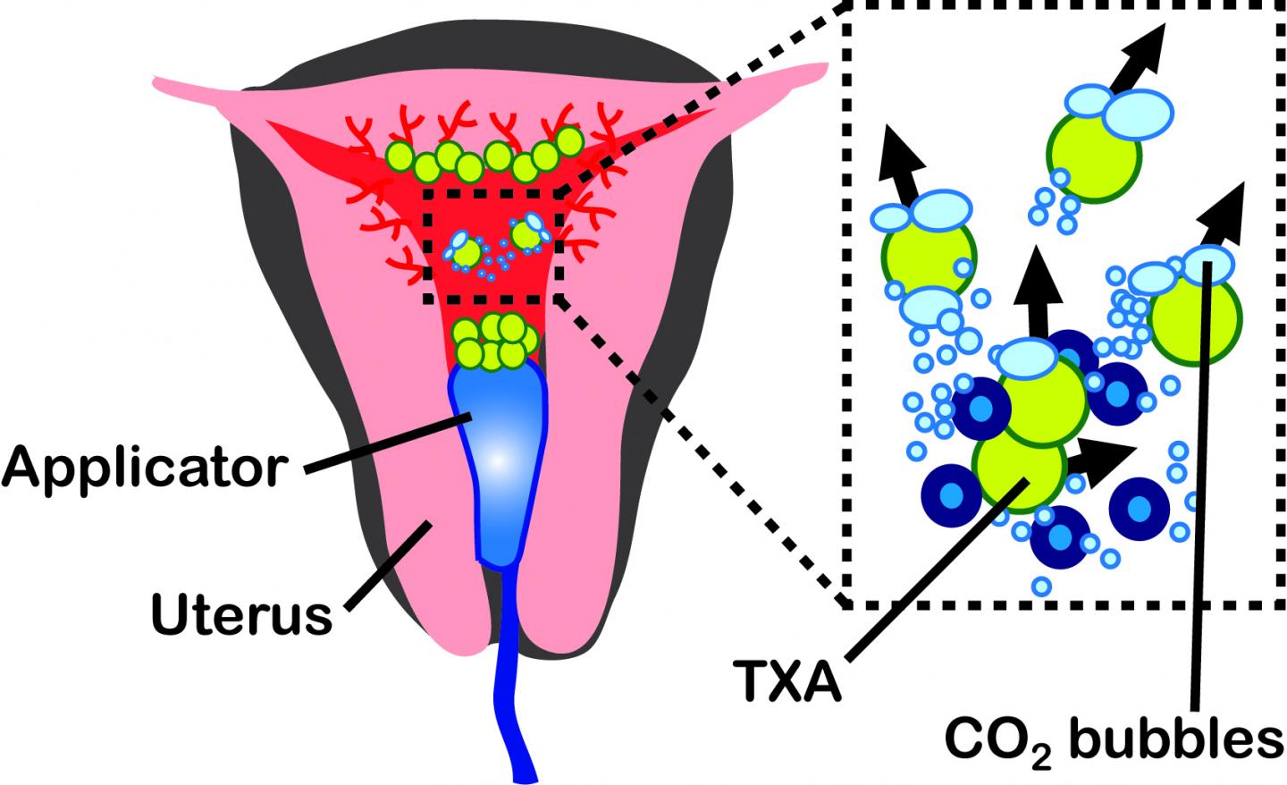 Gas-Propelled Microparticles Travel Deep Into | EurekAlert!