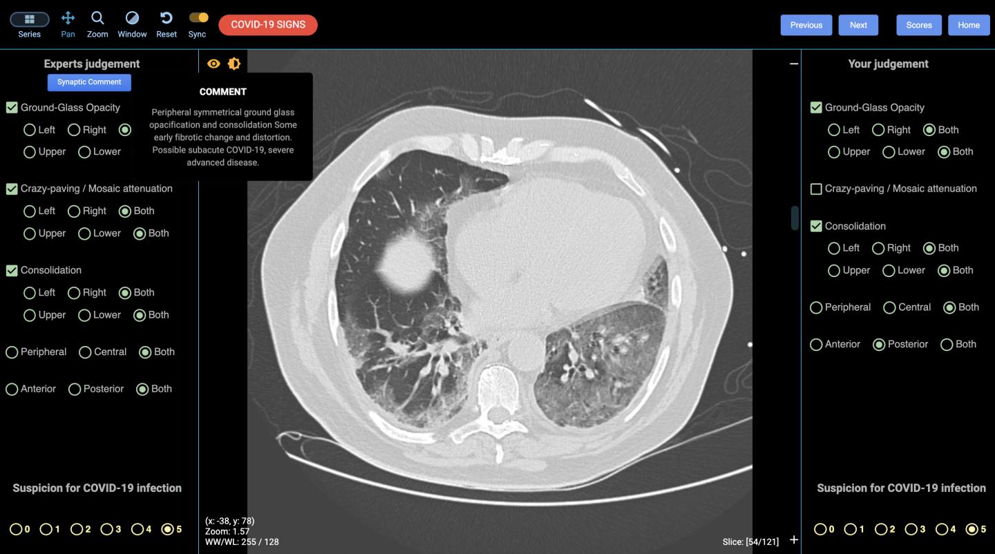 Lung CT with COVID-19
