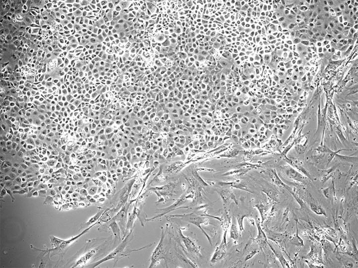 Cells Isolated from a Malignant Pleural Effusion