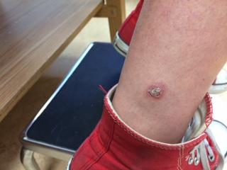 Social Media Helps Diagnose Parasitic Disease in Teen Travelers