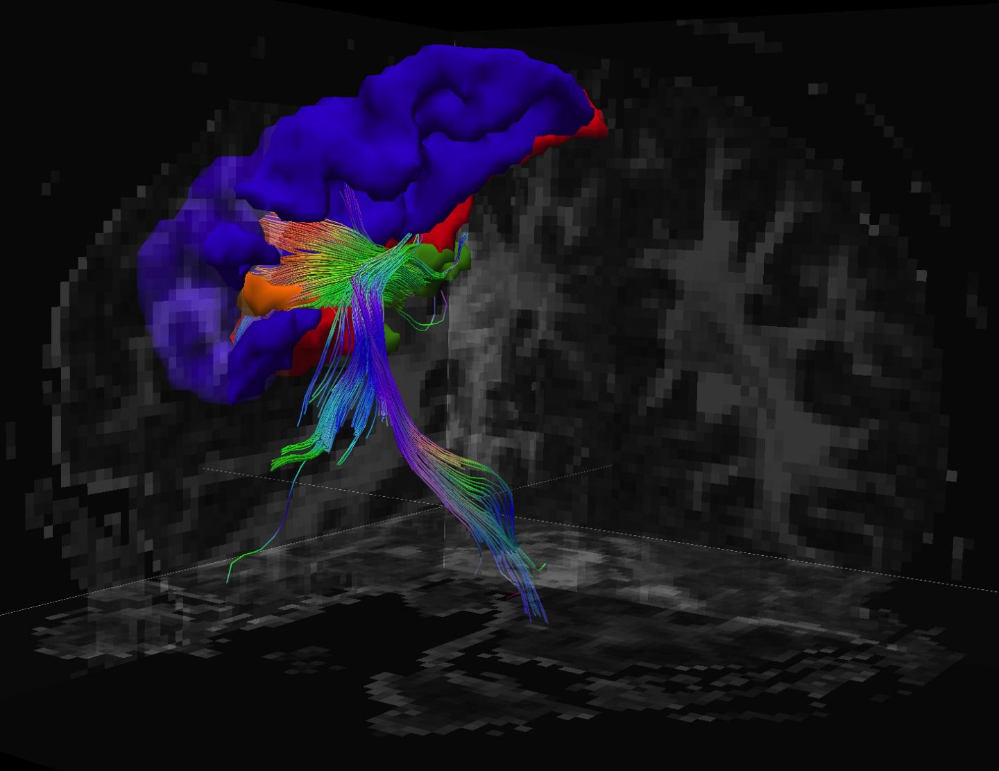 White Matter Hyperintensities in Young Hockey Player's Brain