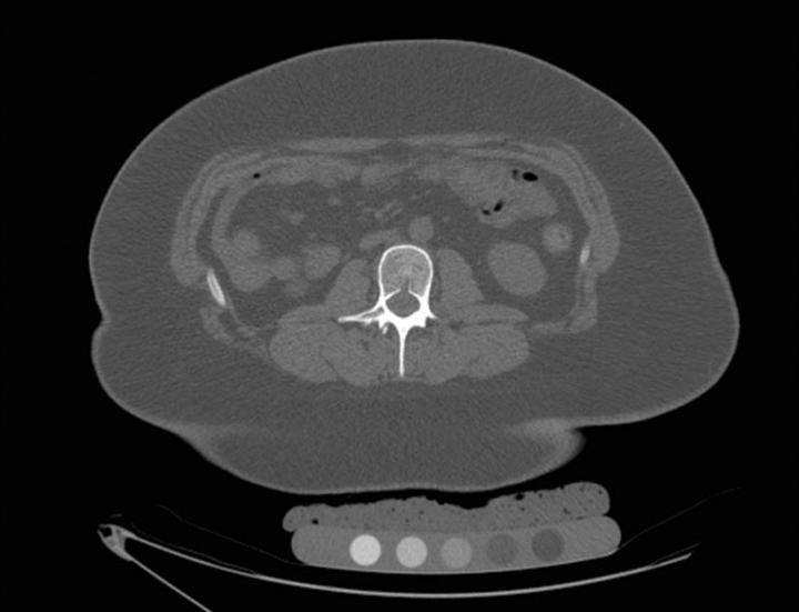 Popular Weight-Loss Surgery in Teenagers Weakens Bones