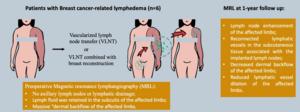 Vascularized Lymph Node Transfer Restores Lymphatic Flow in Extremity Lymphedema