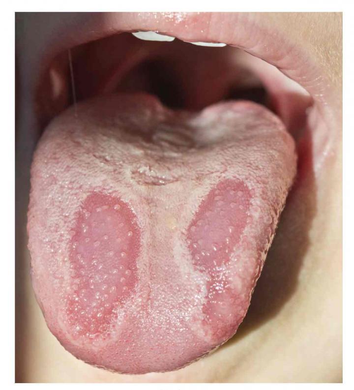 Geographic Tongue Patterns