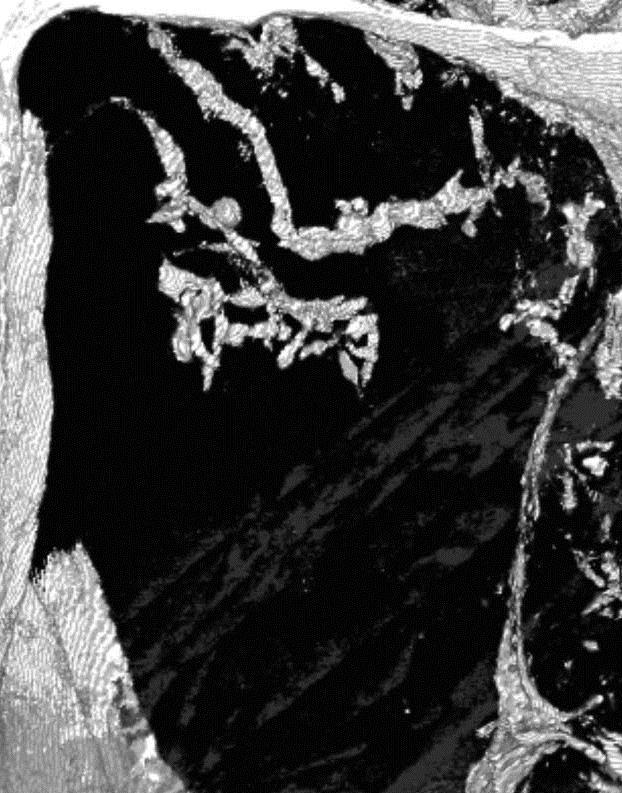 Heart Disease (2 of 3)