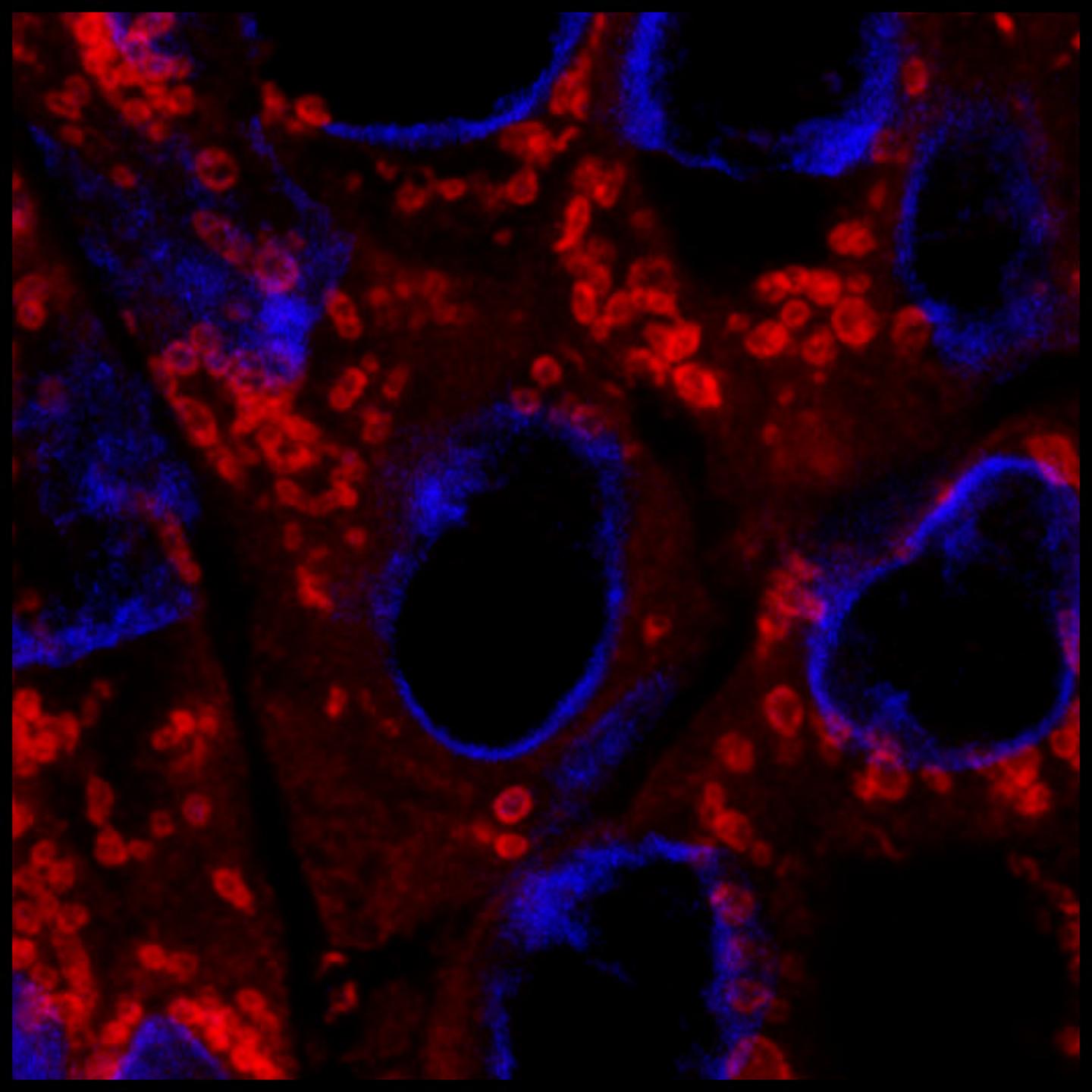 Breast Tumor Cells