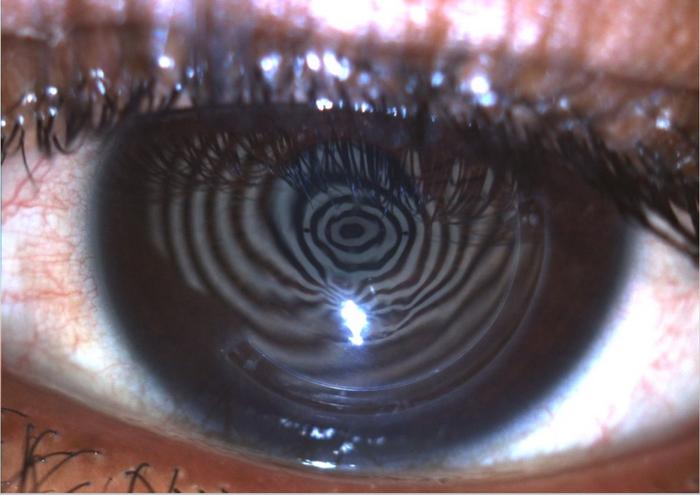 Placido disk reflected off eye with keratoconus