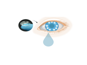 Smart Contact Lenses for Cancer Diagnostics and Screening