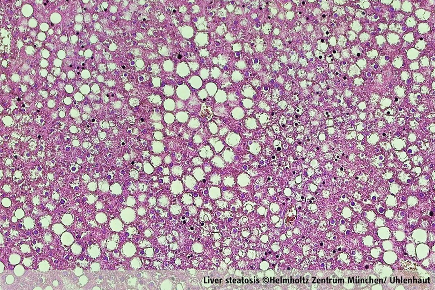 Example of Fatty Liver.