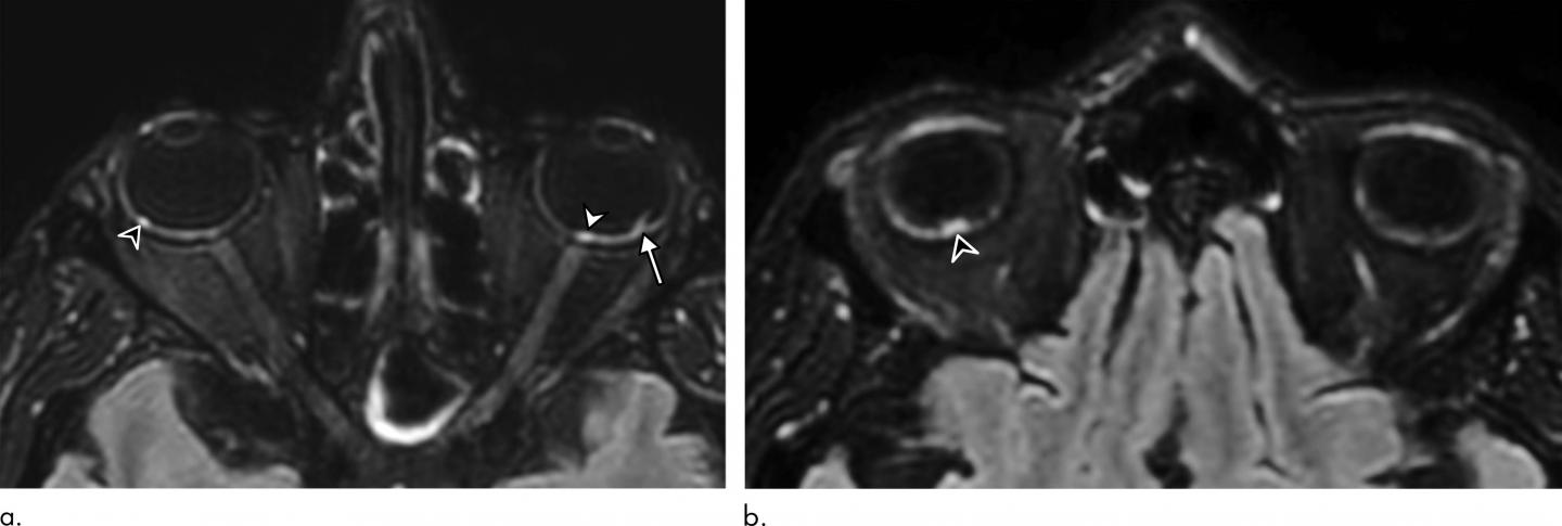 COVID-19 Linked to Potentially Dangerous Eye Abnormalities