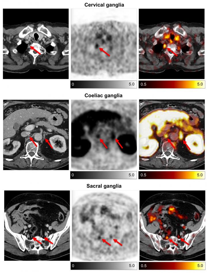 <sup>68</sup>Ga-PSMA-HBED-CC Uptake of Cervical, Coeliac and Sacral Ganglia