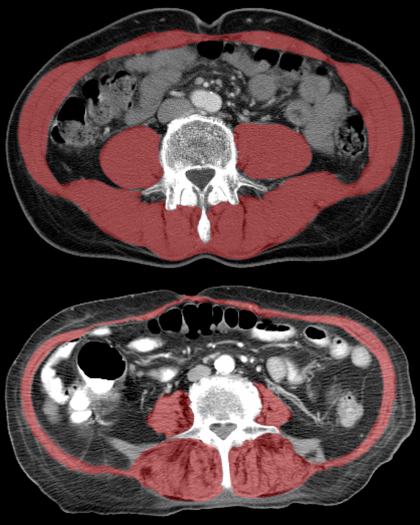 Image of Muscle from CT Study