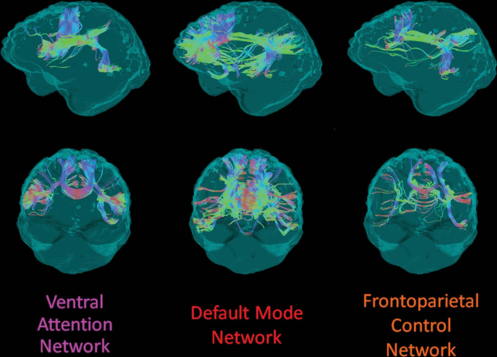 White Matter Integrity Disrupted in People with Alzheimer’s Gene Mutation
