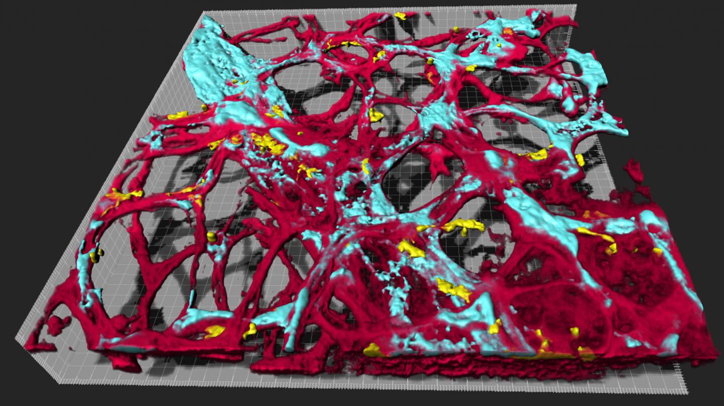 Diabetes Drug Disrupts Death-Defying Cells Driving Eye Disease (1 of 2)