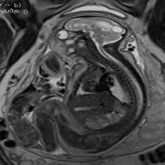 Figure 3: Sagittal at 37 Weeks