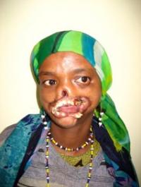 Fighting Childhood Disfigurement in the Congo (2 of 2)