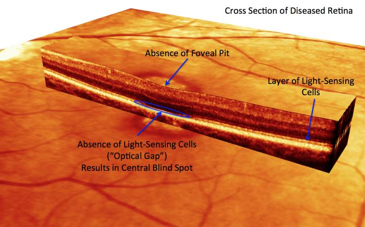 Optical Coherence Tomography