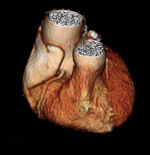 CT Shows Enlarged Aortas in Former Pro Football Players (1 of 3)