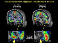 Tau Lesions and Senile Plaques in Alzheimer's Disease