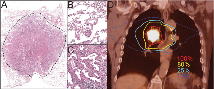 Lung Cancer Radiotherapy