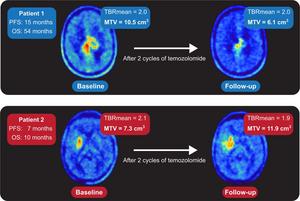 Representative 18F-FET PET images at baseline and follow-up of glioma patients.