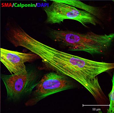 Mitosis Goes Amiss in Children with Deadly Aging Disorder