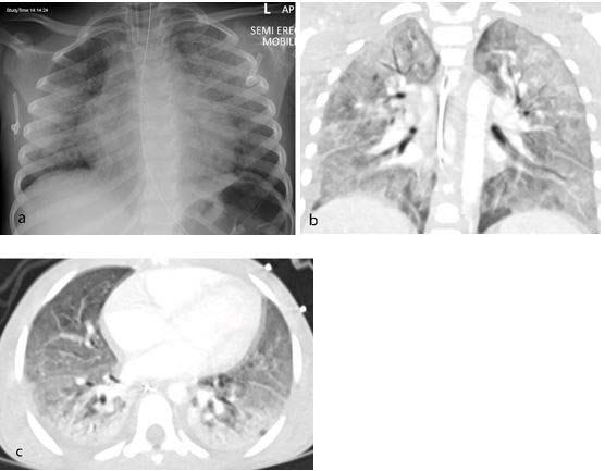 New Study Looks at Post-COVID-19 Emerging Disease in Children