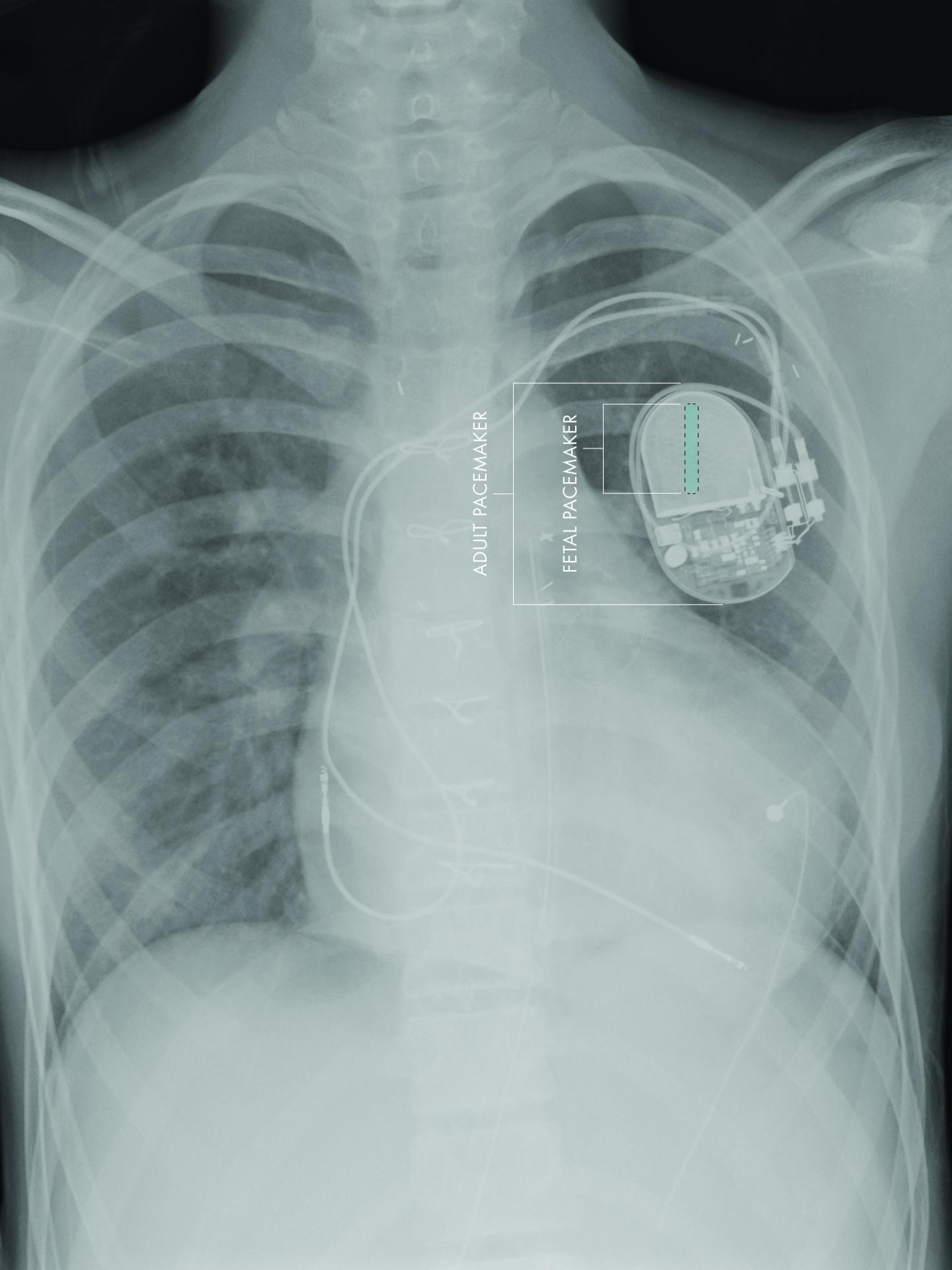 Fetal vs. Adult Pacemaker